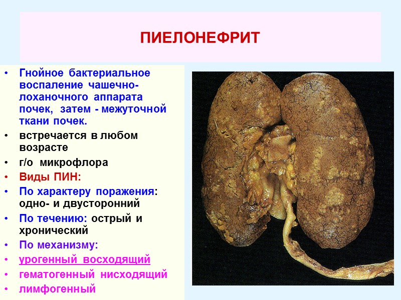 ПИЕЛОНЕФРИТ   Гнойное бактериальное воспаление чашечно-лоханочного аппарата почек,  затем - межуточной ткани
